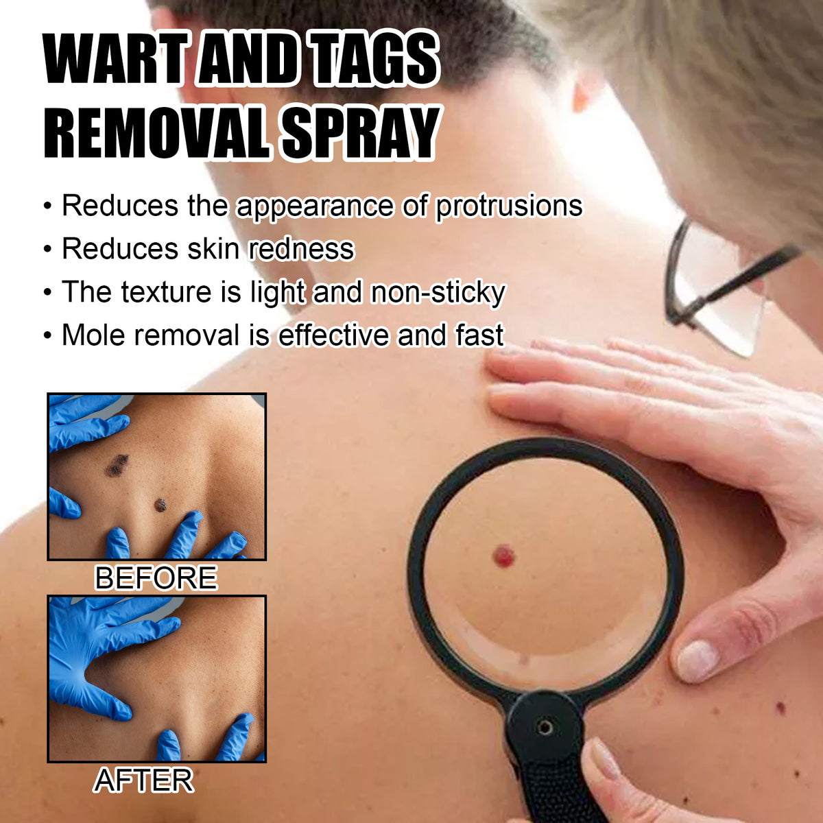 תרסיס להסרת יבלות ותגי עור, לניקוי ולטשטוש שומות בגוף ולשיקום עור חלק