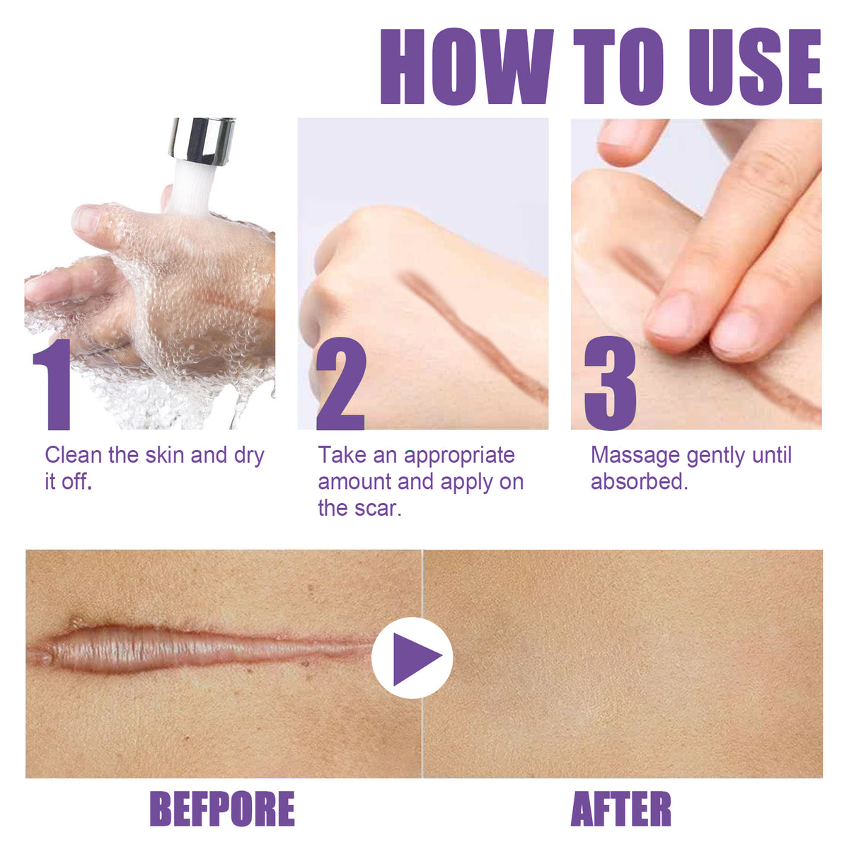 scar treatment cream