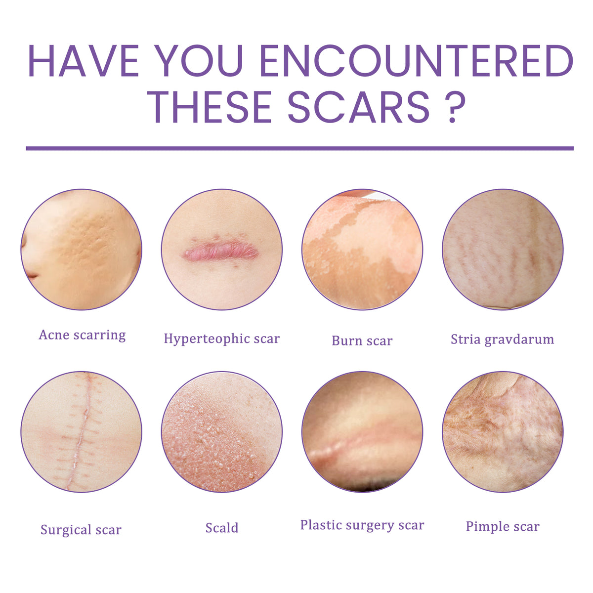 scar treatment cream