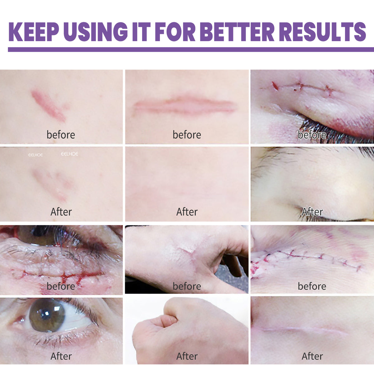 scar treatment cream