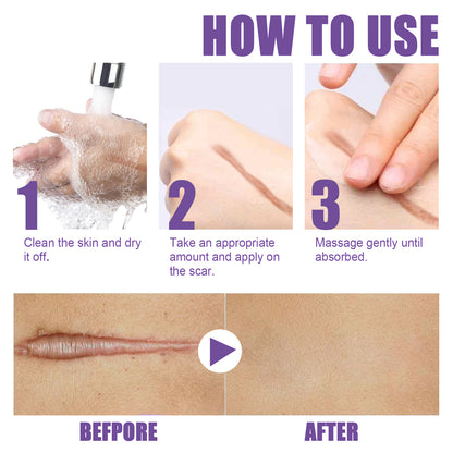 scar treatment cream
